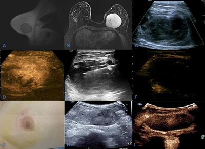 Ultrasound-guided microwave ablation for giant breast leiomyoma: A case report